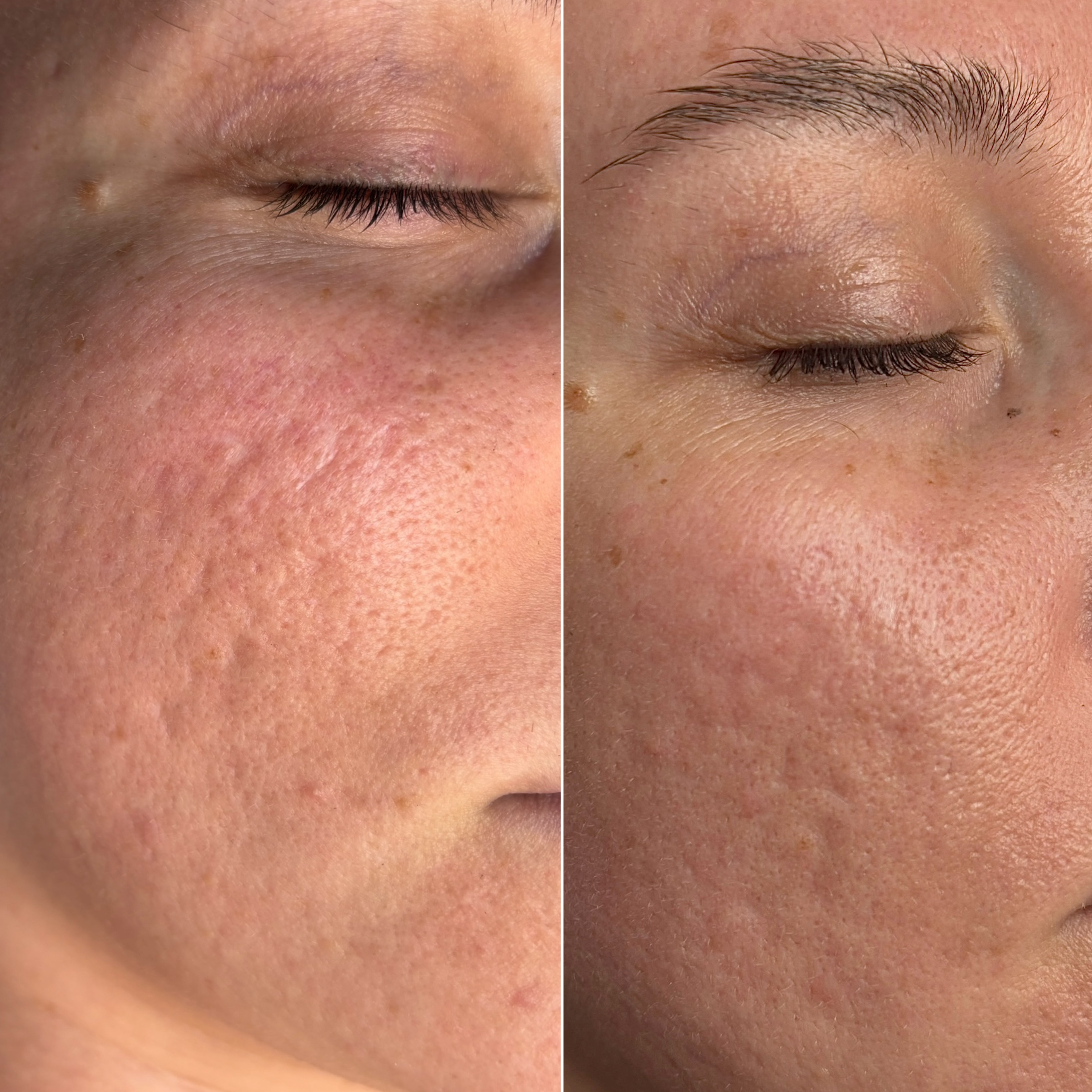 Acne scar treatment result