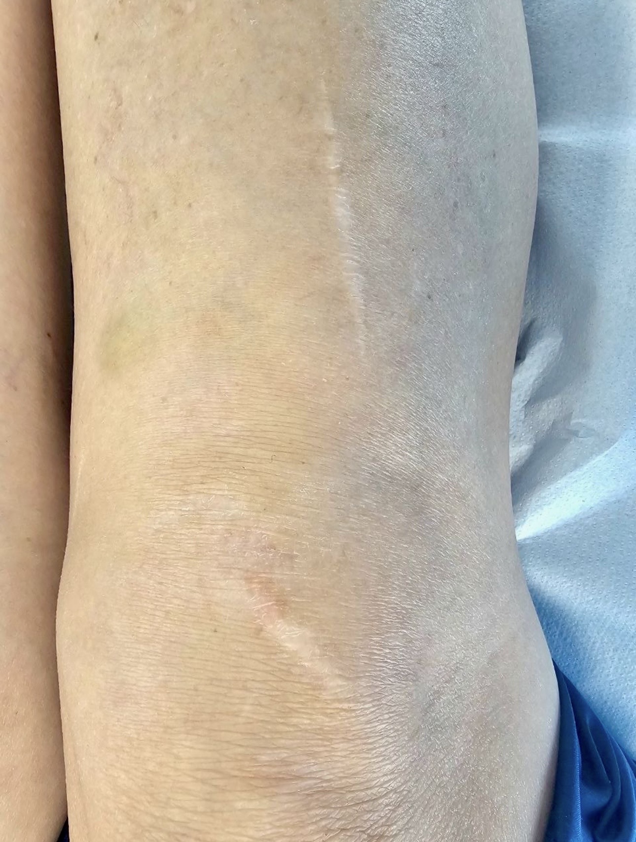 Surgical scar — after