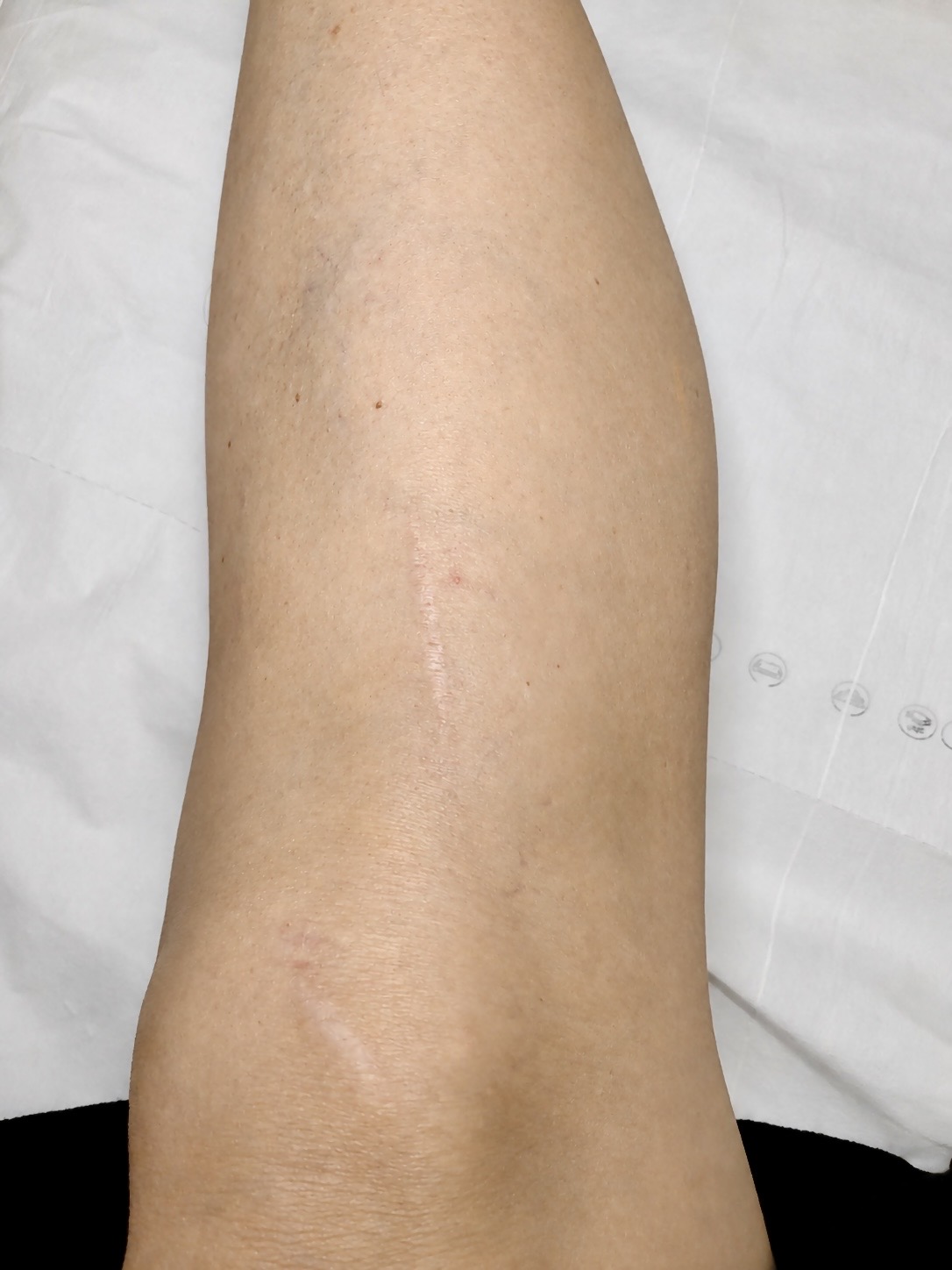 Surgical scar — before