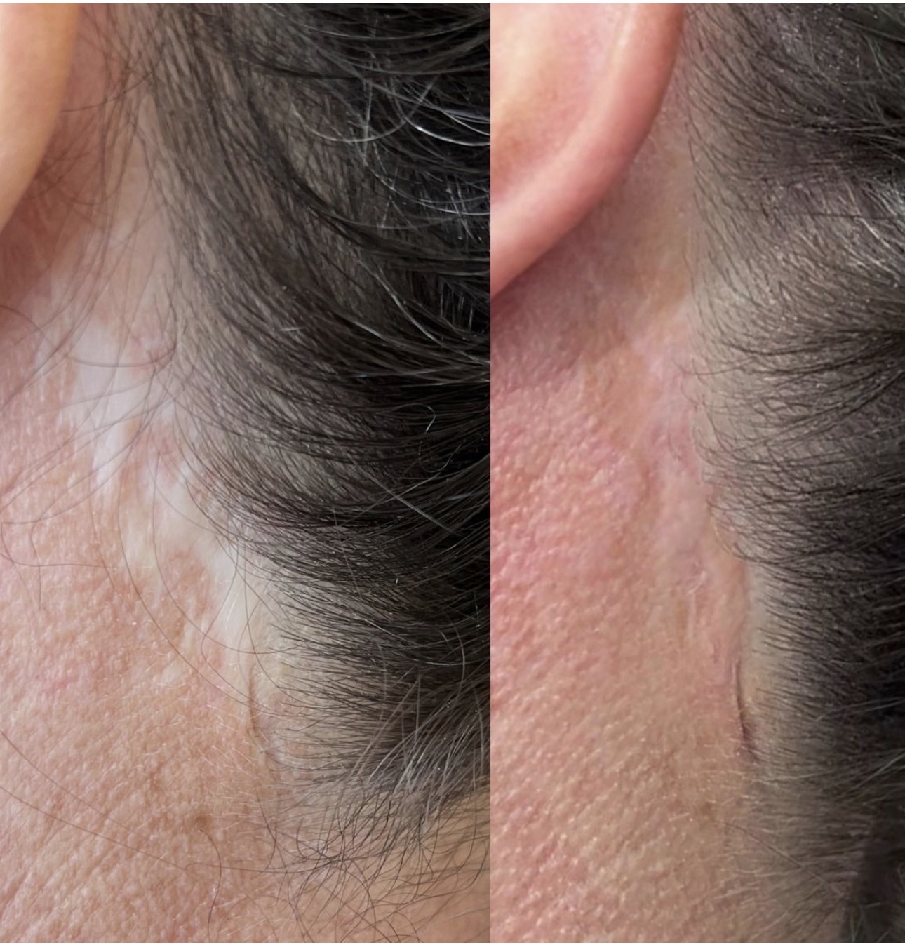 Scar camouflage — before (left) and after (right)