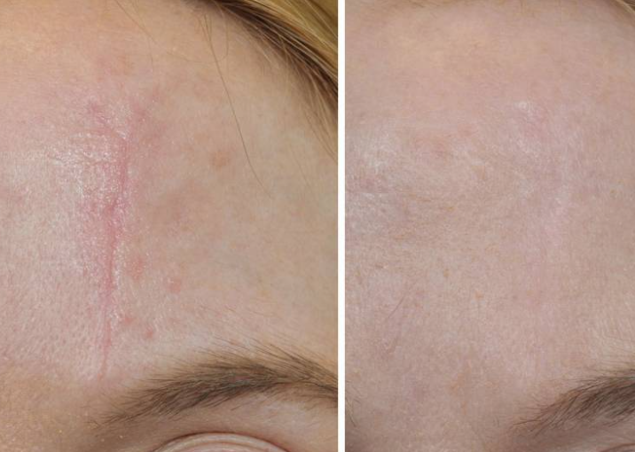 Treatment result