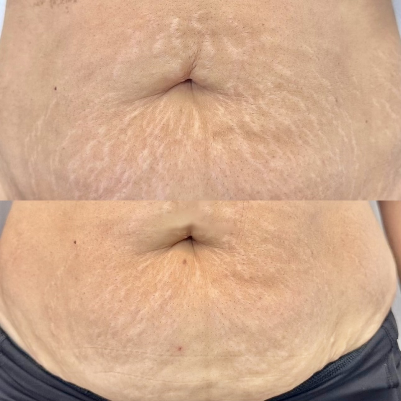 Stretch mark restoration — before (top) and after (bottom)